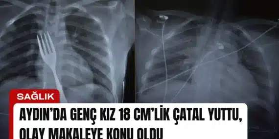 Aydın’da Genç Kız 18 cm’lik Çatal Yuttu, Olay Makaleye Konu Oldu
