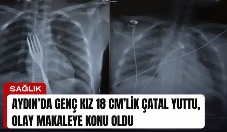 Aydın’da Genç Kız 18 cm’lik Çatal Yuttu, Olay Makaleye Konu Oldu