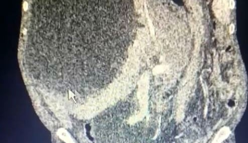 Hastanın karaciğerinden 90 santimetrelik kedi-köpek kisti çıkarıldı